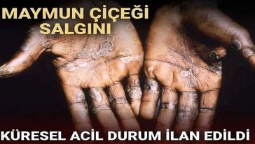 Maymun çiçeği salgını... Dünya Sağlık Örgütü küresel 'acil durum' ilan etti..!