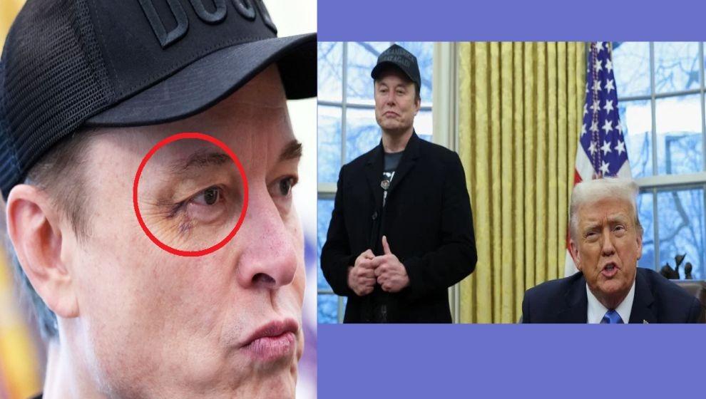 Elon Musk'ın gözündeki morluk dikkat çekti..!