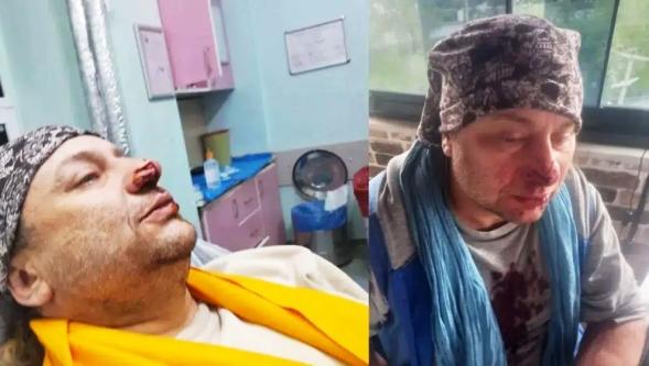 Şarkıcı Onur Akay entübe edildi... Pitbull ısırdı, et yiyen bakteri iddiası gündeme geldi!