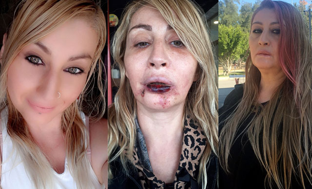 Operasyon sonrası dudağı çürüyen kadın hayatının şokunu yaşadı
